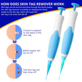 Skin Tag Remover